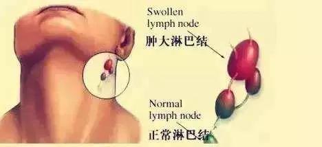 淋巴