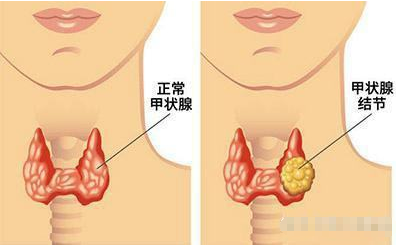甲状腺人体的“发动机”如何自查甲状腺是否安好？