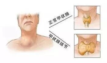 重庆甲状腺