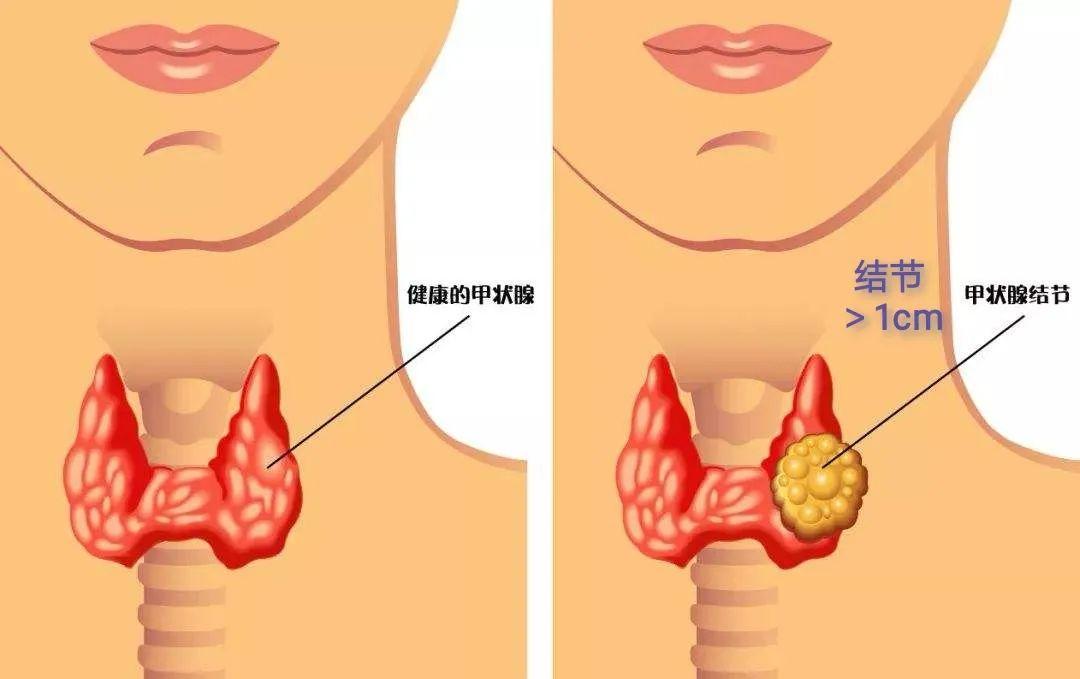 甲状腺