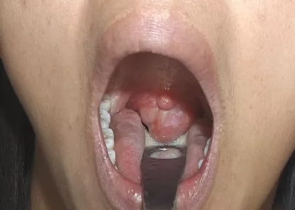 重庆甲状腺医院