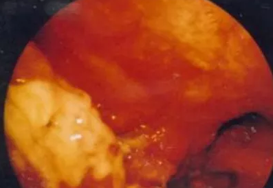 重庆甲状腺医院