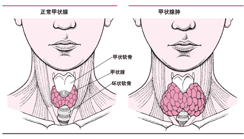 甲状腺肿大