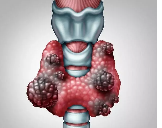 甲状腺癌