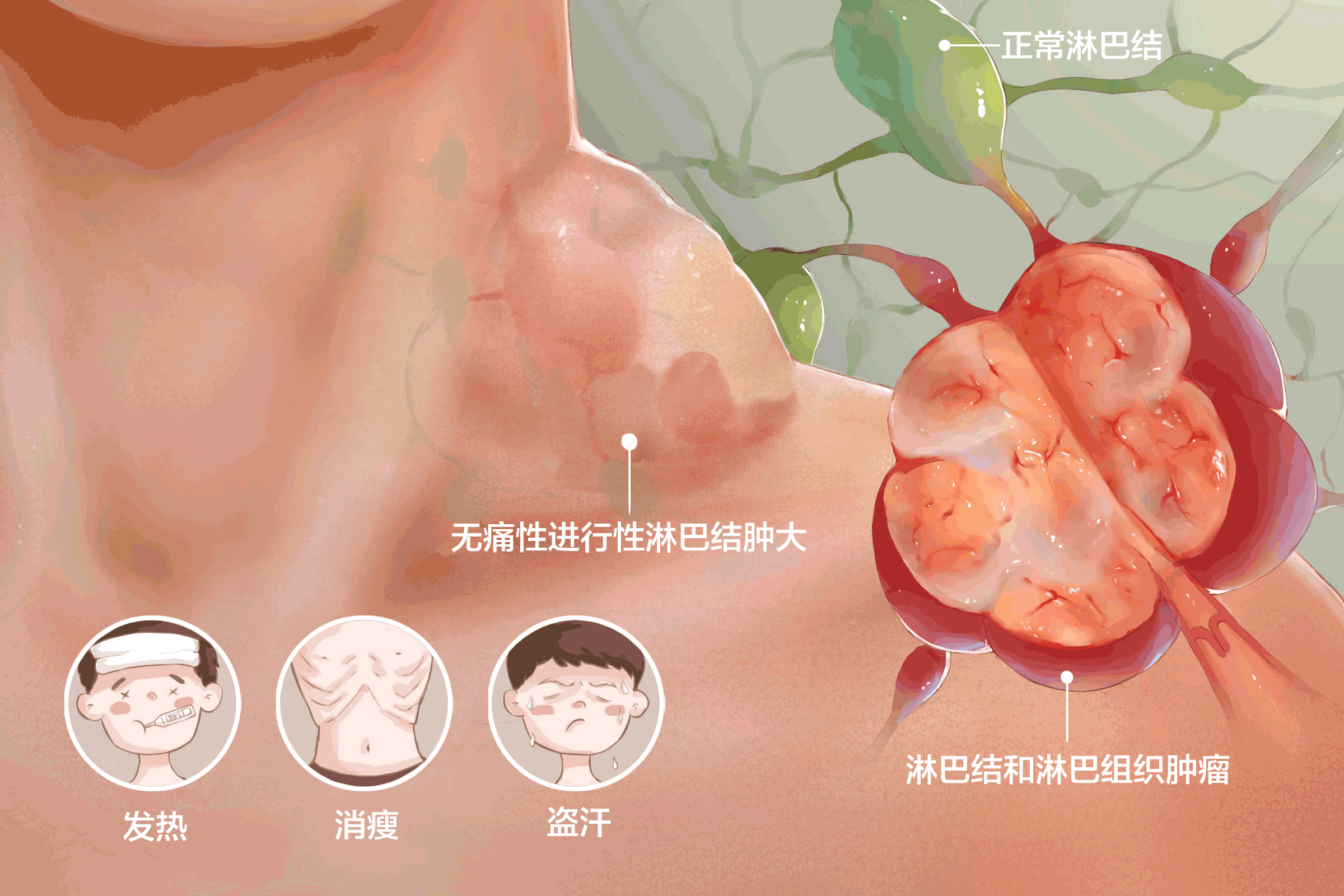 淋巴瘤