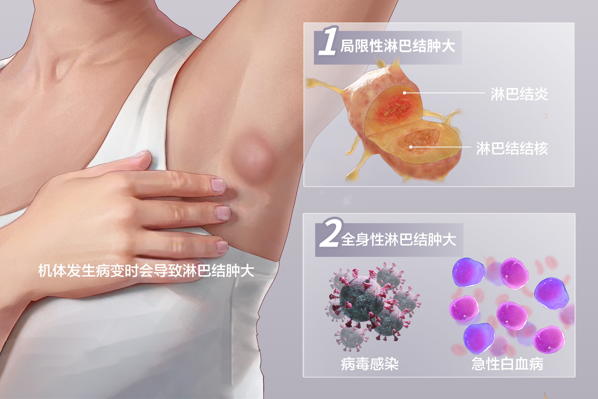 淋巴结肿大