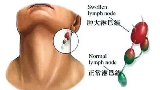 淋巴分布
